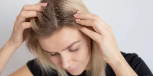 Read more about the article Dandruff: Symptoms, Causes & Treatment