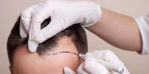 Read more about the article 10 Things to Avoid After Hair Transplant Procedure
