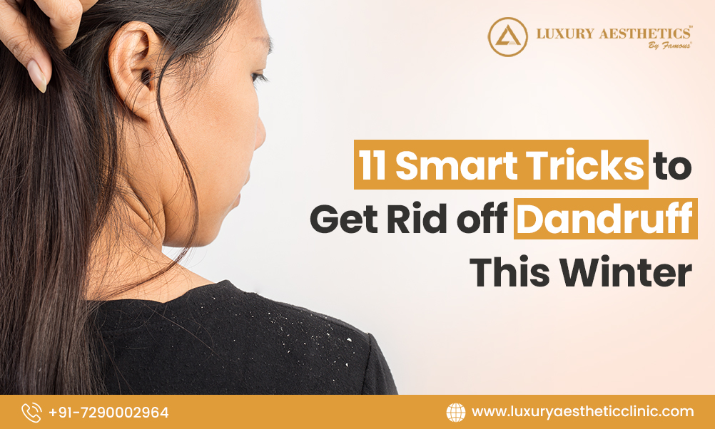 Read more about the article Dandruff: 11 Smart Tricks to Get Rid of Dandruff This Winter